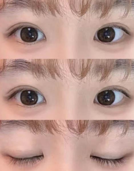 深圳双眼皮修复向萌娟和王志东哪个医生做眼修复技术好?