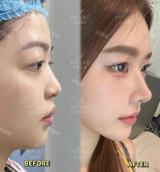 南京隆鼻修复专家刘昭政和林金德哪个鼻子修复技术好?