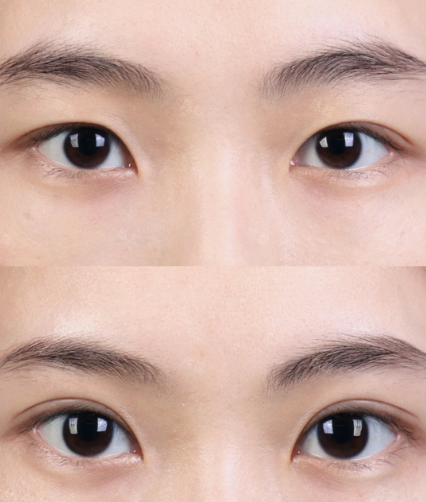 大连割双眼皮专家王洁晴和李研哪个医生做双眼皮好?