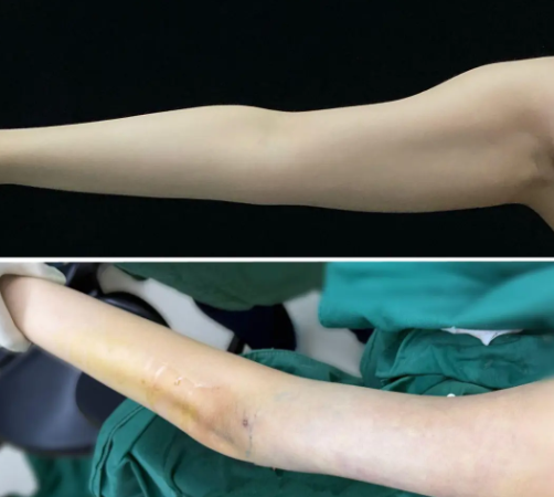 沈阳吸脂哪个医生好?冷冰、王晨超、王迪做脂肪吸脂谁技术最好?