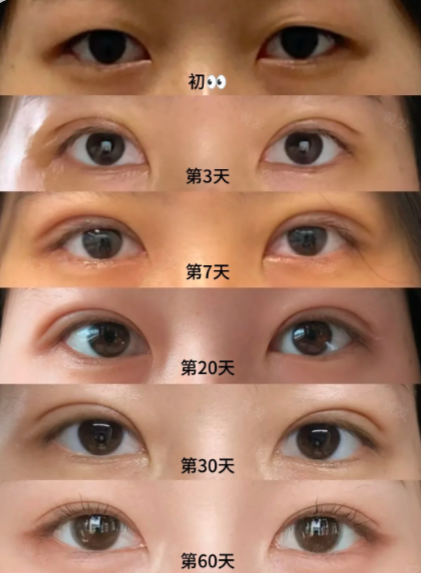 2026南京双眼皮医生哪个好?黄发、朱喆辰、王金明、刘宁做双眼皮谁厉害?