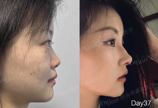 重庆隆鼻专家田永华和王旭明哪个医生技术好?