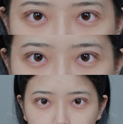 重庆双眼皮专家卢美均和王方鹏哪个医生做双眼皮好?