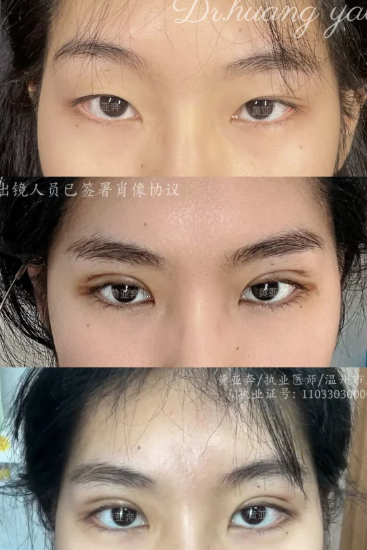 温州黄亚奔、应胡足和李力群哪个医生割双眼皮技术好?