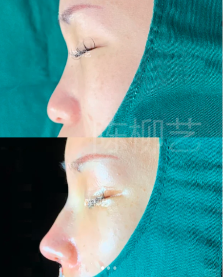 苏州隆鼻专家陈柳艺和张亮哪个医生做鼻子口碑好?