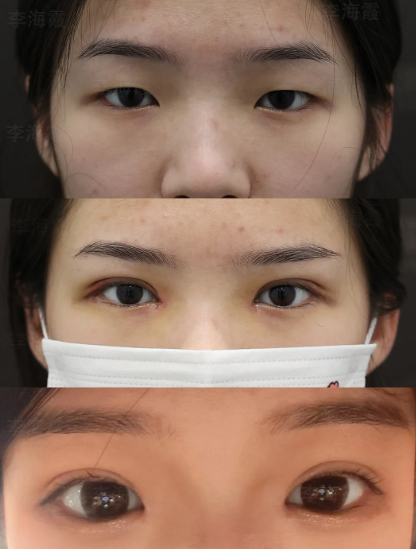 石家庄李海霞和郝俊哪个医生双眼皮技术好?