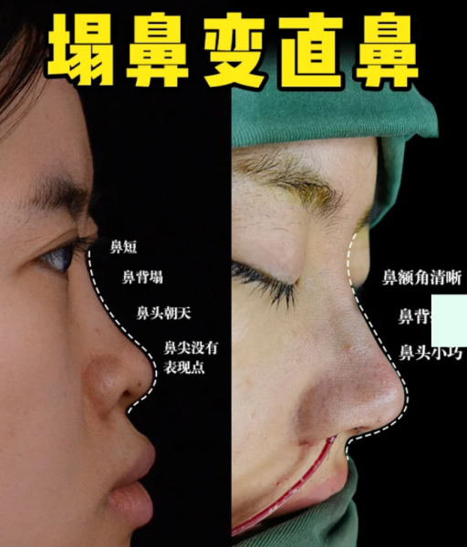 合肥隆鼻医生赵士俊和孙洋哪个技术好?赵士俊孙洋做鼻子谁好?