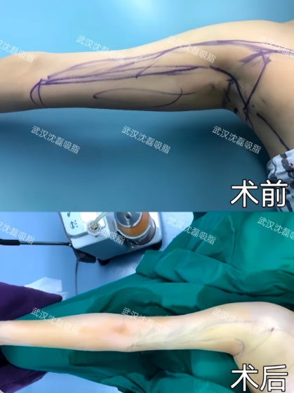 武汉吸脂哪个医生技术最好?朱继锋、陈克、沈磊、包涛、杨杰吸脂技术怎么样?