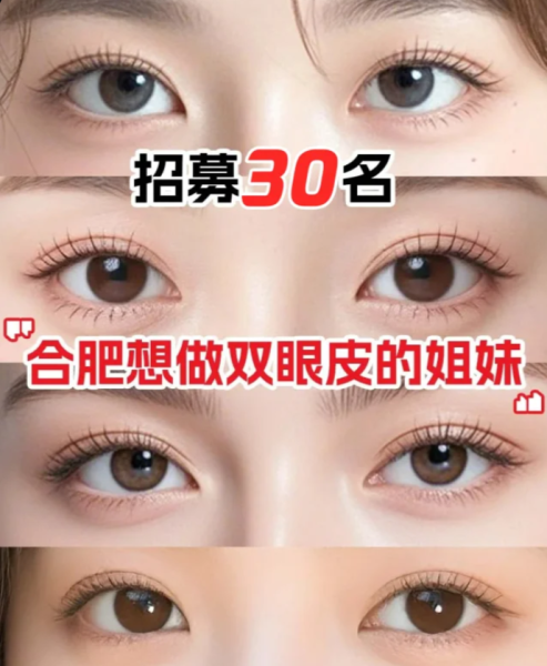 合肥双眼皮医生哪个技术好?李继银、闫品行、朱邦中、曹林、朱慧茹、李树平谁好?