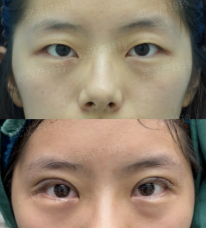 武汉双眼皮专家严玲玲和曹玮哪个医生技术好?