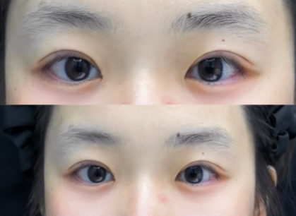 苏州秦丹莹和尹飞哪个医生割双眼皮技术好?