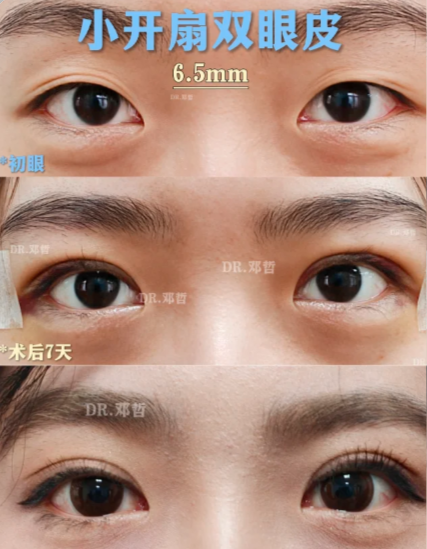 苏州割双眼皮专家邓哲和谢晓明哪个医生做双眼皮口碑好?