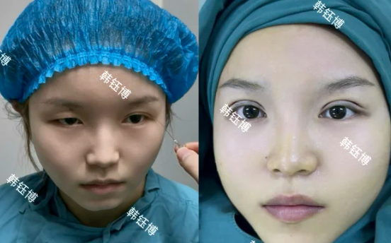 2026年西安双眼皮韩钰博、孙峰和傅先军哪个医生做的好?