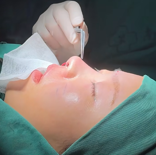 南京隆鼻专家曹海峰和陈天杰哪个鼻修复技术好?