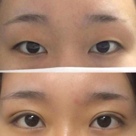 大连做双眼皮专家赵穆欣和李研哪个医生割双眼皮口碑好?