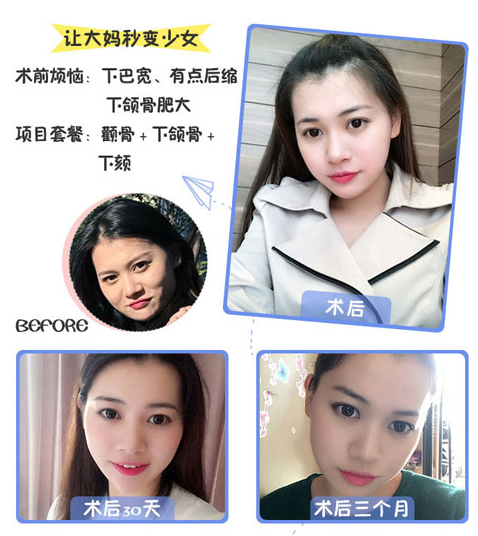 李继华做磨骨效果好不好？李继华做磨骨手术怎么样？安全吗？