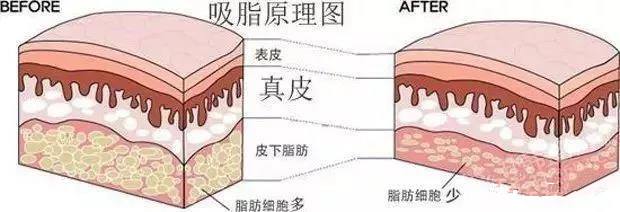 大腿吸脂后出现凹凸不平好后悔啊？可以修复吗？