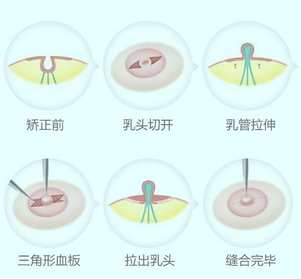 为什么要做乳头内陷矫正？乳头内陷有哪些危害？乳头内陷矫正的方法有哪些？