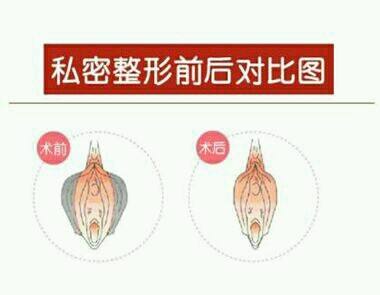 大阴唇整形和小阴唇整形是一回事吗？阴唇整形常识（图）