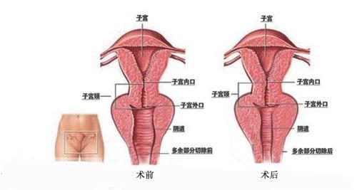 大阴唇整形和小阴唇整形是一回事吗？阴唇整形常识（图）