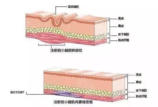 打了溶脂针后悔死了 溶脂针副作用有哪些？