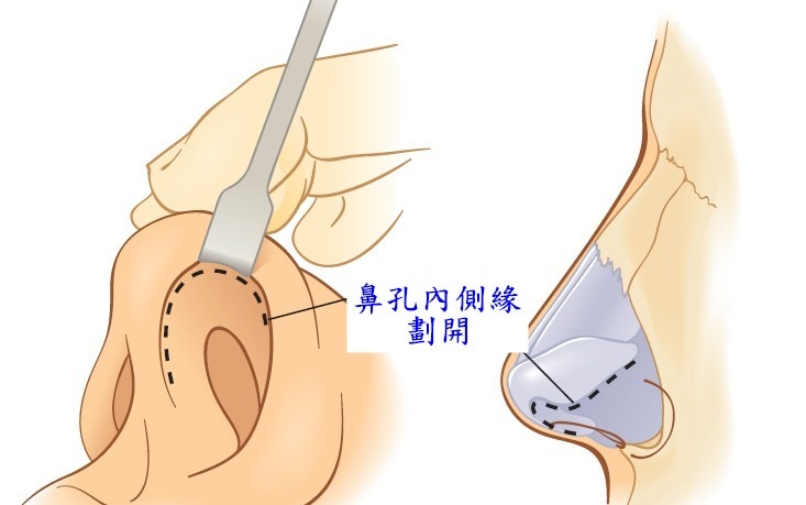 鼻整形奥秘（五）：隆鼻手術的方式有哪些? 如何選擇適合自己的手術方式呢?