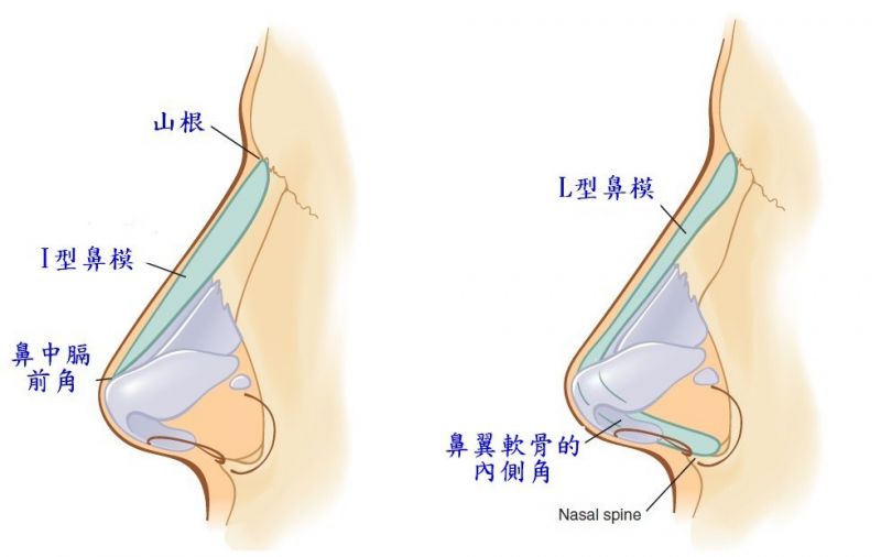 鼻整形奥秘（七）：什么是韩式隆鼻? 韩式隆鼻（韩式生科）有多少段式?