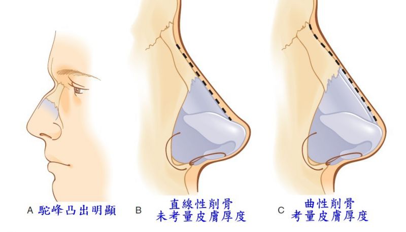 鼻整容奥秘（四）：鼻整形手术前评估重点为何? 敲鼻骨是什么意思?