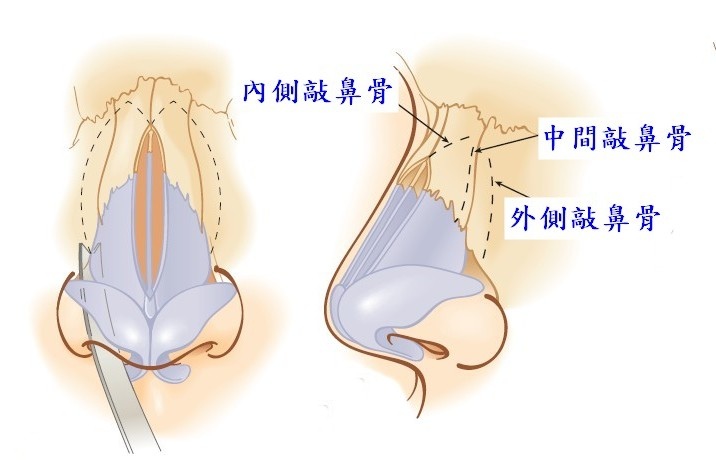 鼻整容奥秘（四）：鼻整形手术前评估重点为何? 敲鼻骨是什么意思?