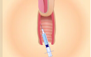 阴道紧缩可以注射玻尿酸吗？女性阴道私密整形常见问题解答