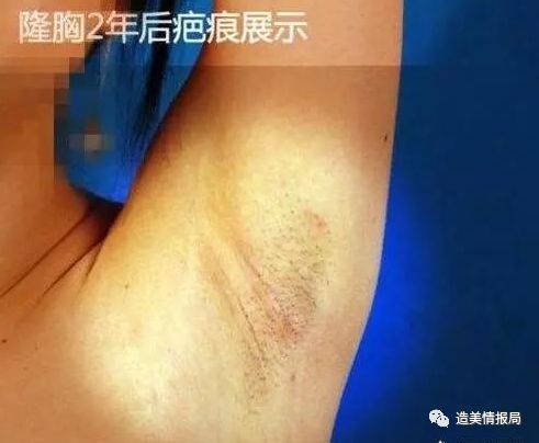 自体脂肪隆胸和假体隆胸的效果、手感、哺乳优缺点全方面对比