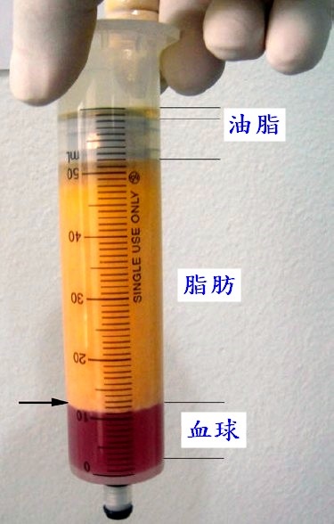 自体脂肪手术不能不说的秘密（六）：脂肪移植存活率多少?怎么移植脂肪效果最好