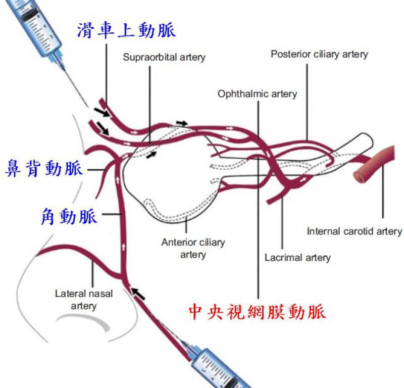 玻尿酸的副作用会导致失明吗？玻尿酸导致失明的原因是什么？