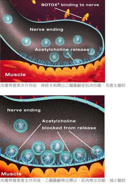 肉毒素的作用机制是什么? 肉毒素在医美上的应用是如何被发现的?