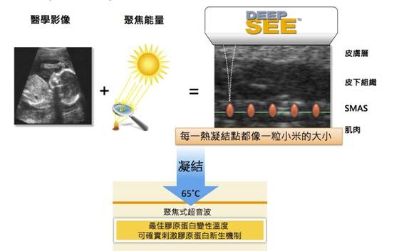 什么是音波拉皮？什么是电波拉皮？音波拉皮和电波拉皮的原理和机制是什么？