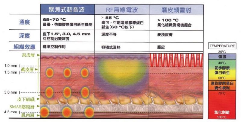 音波拉皮 VS 电波拉皮，哪个会更痛？