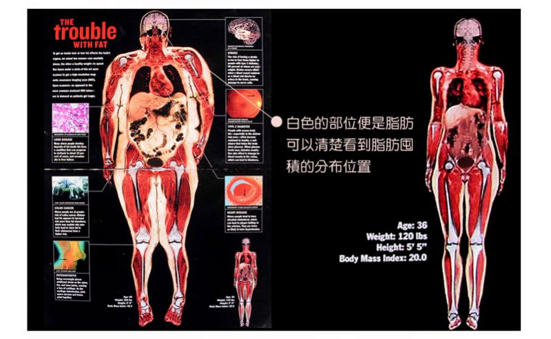 抽脂大学问 各部位脂雕美学：整体美感骨感VS 丰腴