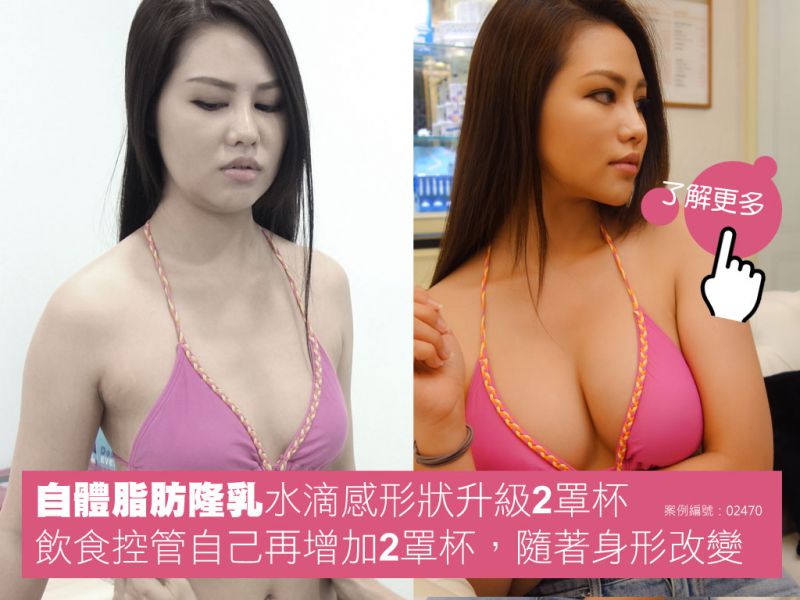 盐水袋、果冻矽胶隆乳,自体脂肪丰胸有什么差别？