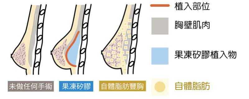 果冻矽胶隆乳和自体脂肪隆胸的区别是什么？自体脂肪隆胸案例精选