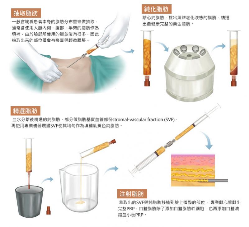 自体脂肪丰胸的成活率一般为多少？