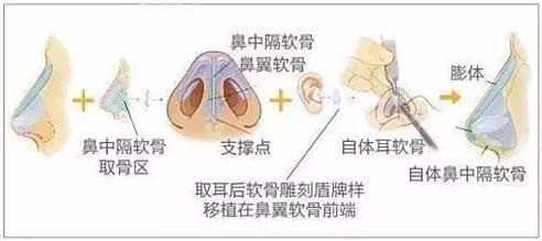 北京八大处整形谢洋春：鼻综合比单纯隆鼻好在哪里？价格案例预约