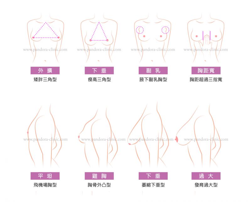 隆乳手术切口在哪里最好？隆胸手术切口优缺点及其胸型分析