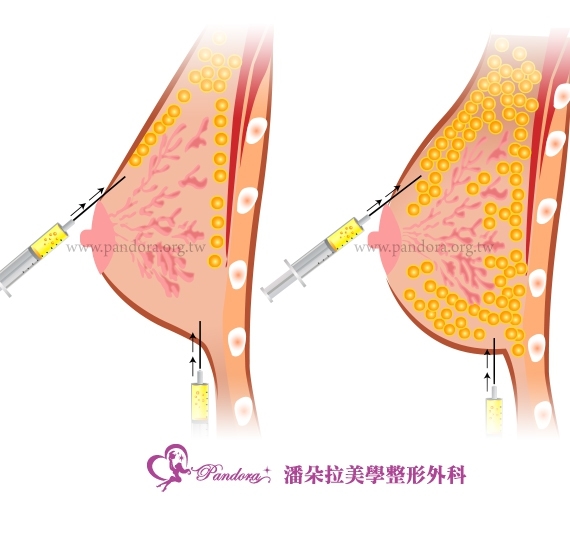  自体脂肪丰胸手术 触感非常自然，丰胸术后不需要按摩