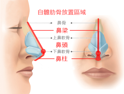 自体肋软骨隆鼻的手术方式是怎样的？自体肋软骨隆鼻术前术后注意事项