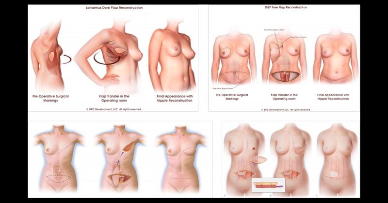 胸部重建（乳房重塑)手术方式和术前术后注意事项
