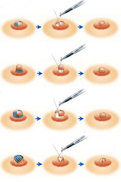 乳头/乳晕简介及其乳头/乳晕术前术后注意事项