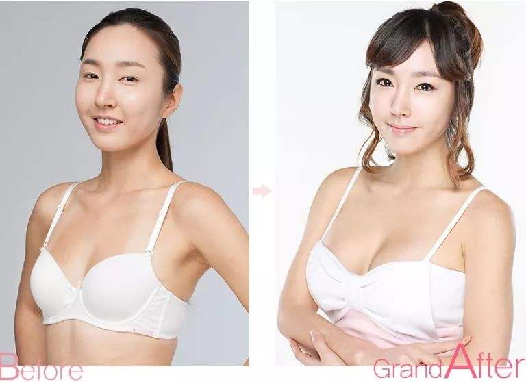 【复合式隆乳】果冻硅胶隆乳合并自体脂肪丰胸优点和注意事项