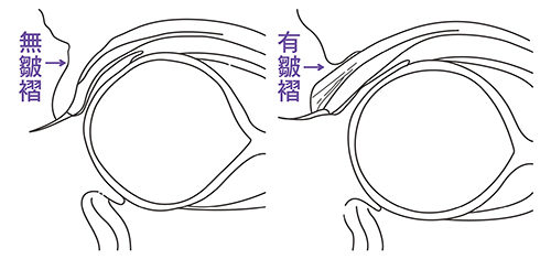 缝双眼皮是埋线双眼皮吗？缝双眼皮有哪些优点？