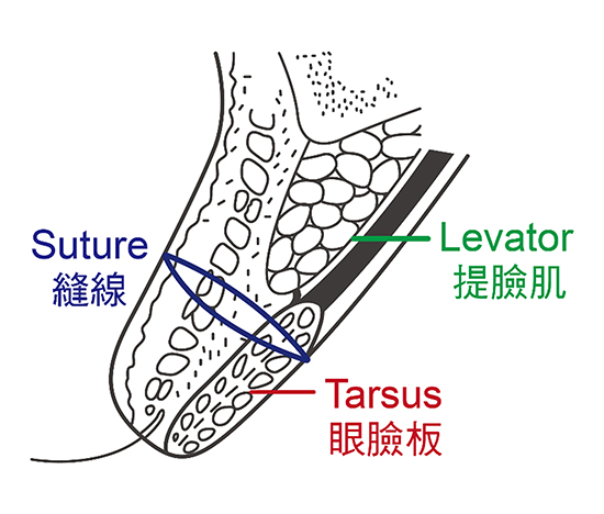 缝双眼皮是埋线双眼皮吗？缝双眼皮有哪些优点？