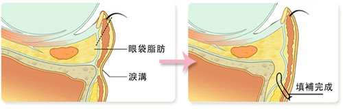 眼窝凹陷怎么办？眼窝补脂（眼窝填充）的手术方式和术后保养